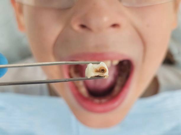 Best Emergency Tooth Extraction in Brighton, MI